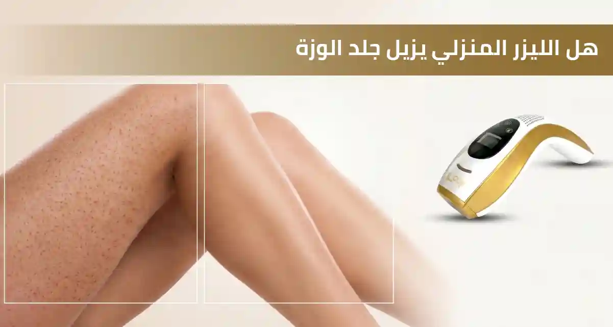 هل الليزر المنزلي يزيل جلد الوزة