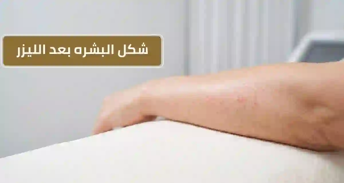 شكل البشره بعد الليزر