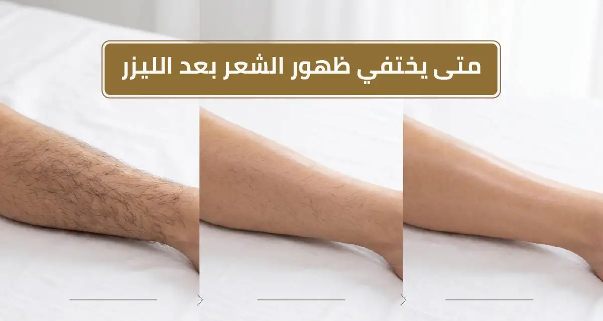متى يختفي ظهور الشعر بعد الليزر